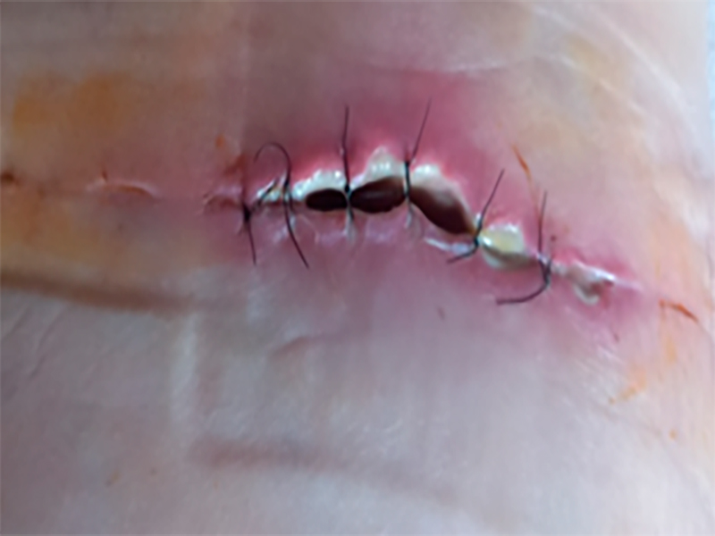 Deiscência de sutura