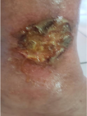 Úlcera Vasculogênica