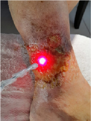 Úlcera Vasculogênica